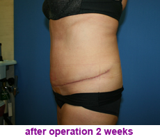 plastic-surgery-tummy-tuck